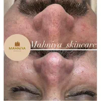 فیشال،آلگاپیل(پوست مار)هایفوتراپی،پوست کره ای|خدمات آرایشگری و زیبایی|قم, دورشهر|دیوار