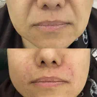 بوتاکس ژل لب خط خنده چانه گونه|خدمات آرایشگری و زیبایی|گرگان, |دیوار