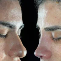 عمل بینی در اهواز|خدمات آرایشگری و زیبایی|اندیکا, |دیوار