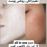 پکیج درمان لک ویژه|آرایشی، بهداشتی، درمانی|تهران, فردوسی|دیوار