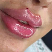 آموزش فیلر ژل بوتاکس نخ لیفت لیزر مو فشیال حجامت|خدمات آموزشی|اصفهان, هزارجریب|دیوار