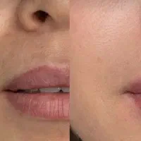 آنزم و مزو تراپی و فیلر و بوتاکس|خدمات آرایشگری و زیبایی|قرچک, مهدیه|دیوار