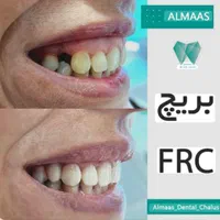 خدمات دندان بریچ frc جایگزین ایمپلنت