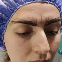 کاشت مو و ابرو VIP با تراکم بالا