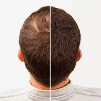 کاشت مو و ابرو در معتبر ترین کلینیک تهران|خدمات آرایشگری و زیبایی|تهران, فاطمی|دیوار