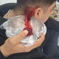 انجام انواع فصد و حجامت تخصصی+آموزش