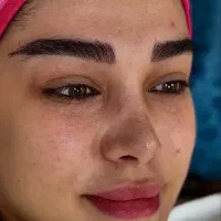 فیشال تخصصی و ریمو تتو زیر نظر پزشک