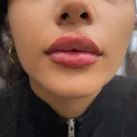 ژل و بوتاکس