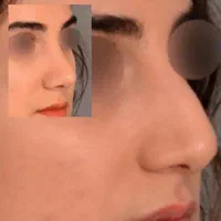 عمل زیبایی بینی|خدمات آرایشگری و زیبایی|شیراز, نیایش|دیوار