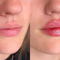 تخفیف تزریق ژل، بوتاکس در منزل|خدمات آرایشگری و زیبایی|گرگان, |دیوار