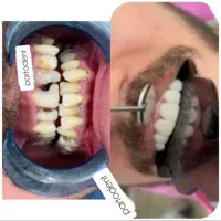 کامپوزیت در منزل. ایذه، باغملک، هفتکل|خدمات آرایشگری و زیبایی|ایذه, |دیوار