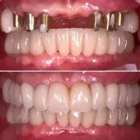 اوردنچر فقط تااخر این هفته به قیمت پارسال|خدمات زیبایی و سلامت|تبریز, |دیوار