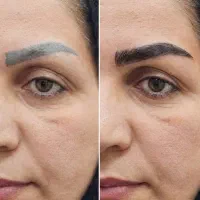 کاشت ابرو / میکرو کاشت با جدید ترین متد در قم