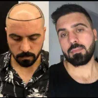 جشنواره کاشت مو در تهران