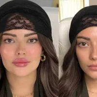 ژل بوتاکس فیلر باسن بیکینی مزوتراپی فشیال خانم اقا
