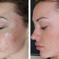 مدل جهت فیشال در مطب زیبایی(بانوان،آقایان)