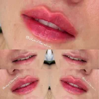 مادلینگ صورت( ژل و بوتاکس)|خدمات آرایشگری و زیبایی|زرقان, |دیوار