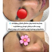 فشیال ایینه شدن صاف شدن مزونیدلینگ رسیدفقط۴۰۰