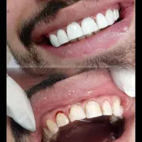 کامپوزیت زیبایی دندان( مدل) فقط توسط دندانپزشک|خدمات آرایشگری و زیبایی|تهران, صادقیه|دیوار