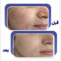 حذف انواع ککومک لک ملاسما و تیرگی در یک جلسه|خدمات آرایشگری و زیبایی|همدان, |دیوار