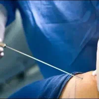 لیپوساکشن مدرن برای کانتورینگ وفرم دهی بدن