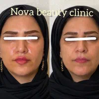 تزریق فیلر بوتاکس هایفو کک و مک جوانسازماساژ فشیال