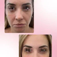 تزریق ژل،لیزر،بوتاکس|خدمات آرایشگری و زیبایی|تهران, یافت‌آباد|دیوار