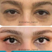 جراحی پلک یا بلفاروپلاستی و جراحی بینی|خدمات آرایشگری و زیبایی|کرج, جهان‌شهر|دیوار