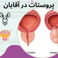 پروستات آقایون