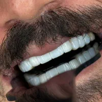 جشنواره کامپوزیت لمینیت روکش عصب ونیر ترمیم بریدج