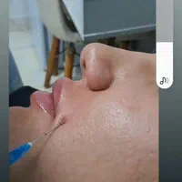 فیلر وژل وبوتاکس|خدمات آرایشگری و زیبایی|تهران, کیانشهر|دیوار