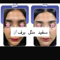 گلوتاتیون/درمان پیسی/روشن کننده کل صورت وبدن|خدمات آرایشگری و زیبایی|اهواز, کیانپارس |دیوار