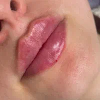 ژل لب فیلر بوتاکس پی ار پی فیلر گونه خط خنده|خدمات آرایشگری و زیبایی|کاشان, طالقانی|دیوار