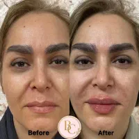 تزریق فیلر لب بادی بوتاکس فول فیس بلفارو غبغب|خدمات آرایشگری و زیبایی|تهران, نیاوران|دیوار