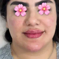 اف ژل بوتاکس فقط هزینه مواد ۸۸۰