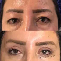 تخفیف ۵۰درصدی بلفارو پلاستی توسط پزشک|خدمات زیبایی و سلامت|کرمانشاه, |دیوار