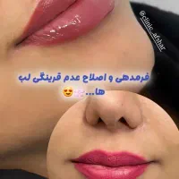 جشنواره تابسانه تزریق فیلر و ژل توسط پزشک.فیشال