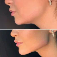 پزشک مزو ژل بوتاکس لب گونه چشم چانه زاویه فیلر prp|خدمات آرایشگری و زیبایی|کرج, گوهردشت|دیوار