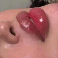 تزریق ژل