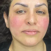 فیلر لب قیمت ویژه وهایفو‌تخفیف فوق العاده