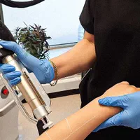 لیزر موهای زائد الکس شاتی بدون ژل