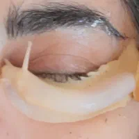 حلزون تراپی