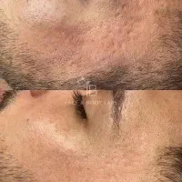 درمان ریشه ای جوش و جای جوش و لک پوستی