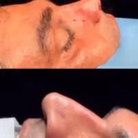 جراحی بینی با تخفیف استثنایی به مدت ۱۰روز|خدمات آرایشگری و زیبایی|بندرعباس, |دیوار