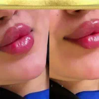 ساکش غبغب تزریق .باسن.شکم