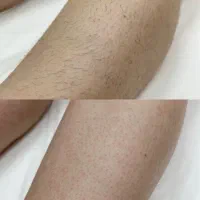 خدمات لیزر و رفع تیرگی و لاغری باتخفیف ویژه|خدمات آرایشگری و زیبایی|بجنورد, |دیوار