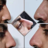 ژل و بوتاکس با ماندگاری بالا و قیمت ویژه|خدمات آرایشگری و زیبایی|شاهین‌شهر, شهرک گلدیس|دیوار