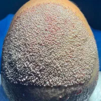 نتیجه‌ای که دیده میشه ، کاشت مو VIP