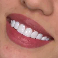 کامپوزیت و ایمپلنت فقط از 800