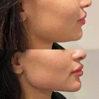 آموزش صفر تا صد زیبایی فیلر و بوتاکس و مزو تراپی|خدمات آرایشگری و زیبایی|اردبیل, |دیوار